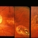Cone Dystrophy